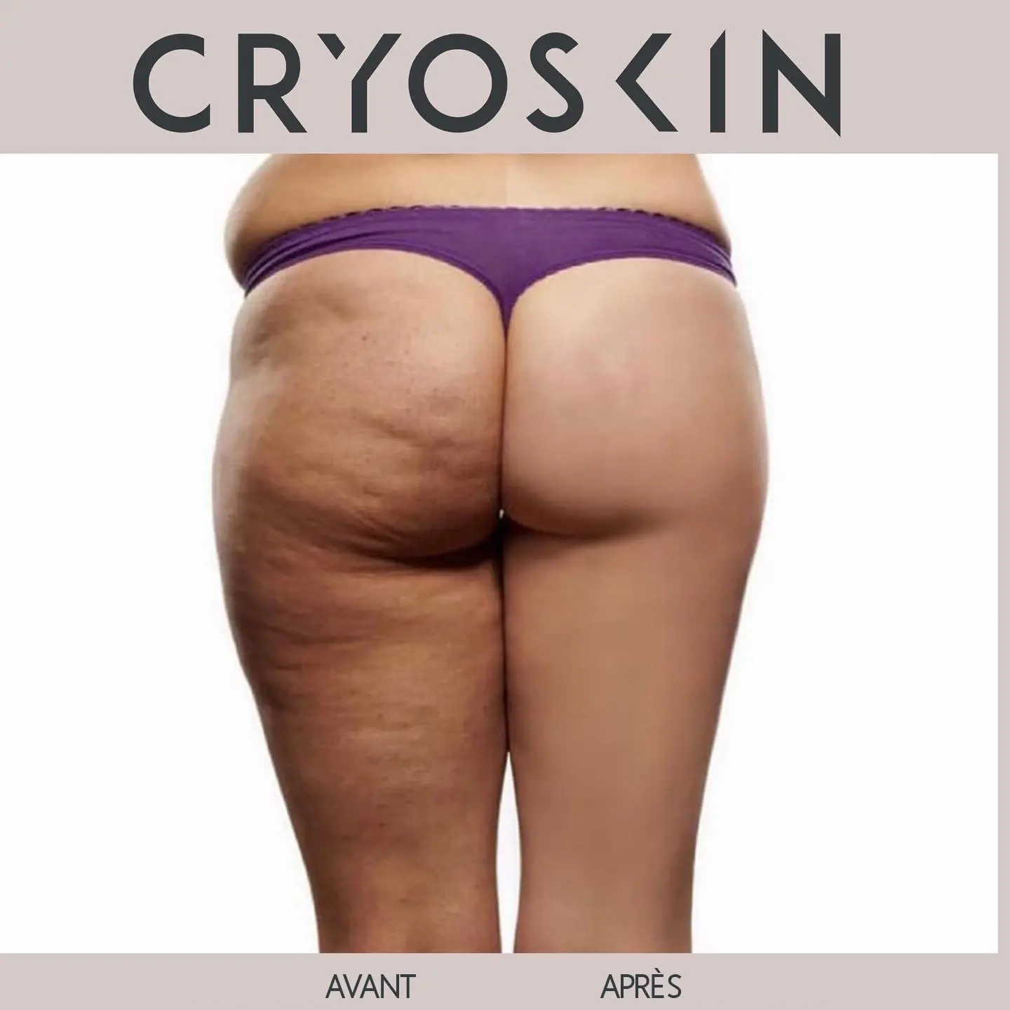 cryoskin11