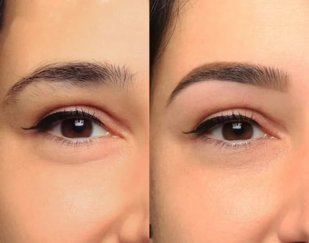 restructuration-sourcils